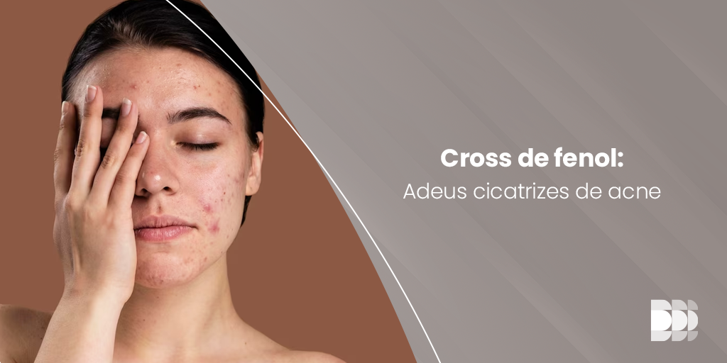 Cross de fenol melhora de cicatrizes de acne