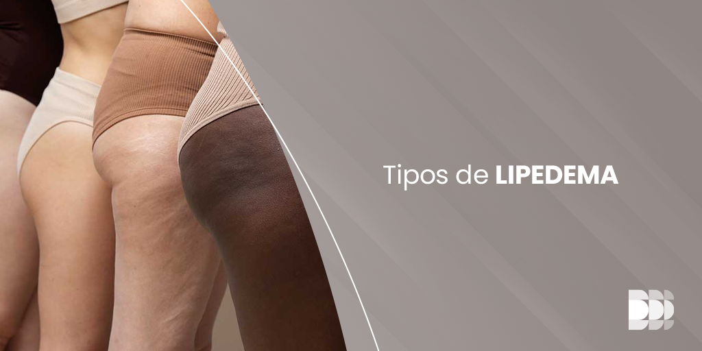 Descubra os tipos de lipedema e como ao Núcleo DOME de Lipedema em Belo Horizonte oferece tratamentos eficazes. Agende sua consulta hoje mesmo!