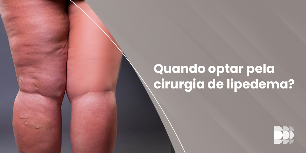 Descubra quando a cirurgia de lipedema é indicada, quais os sinais para considerar essa opção e os benefícios.