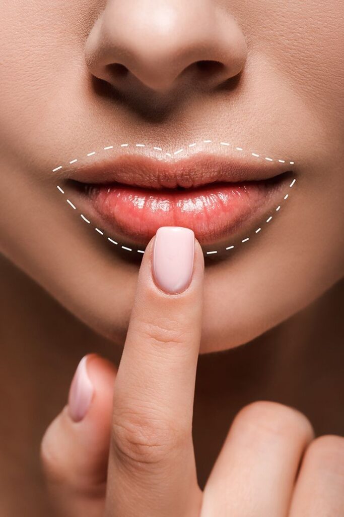 Preenchimento labial com resultado natural e harmonioso